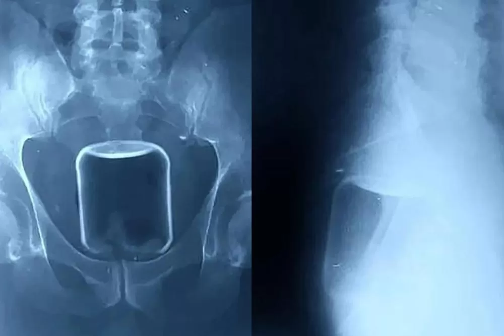 Homem Busca Atendimento Médico Após Introduzir Objeto no Ânus e Viraliza nas Redes Sociais