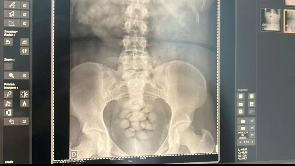 Cacoalense é Presa no Aeroporto Internacional de Viracopos com 100 Cápsulas de Cocaína no Estômago a Caminho da França