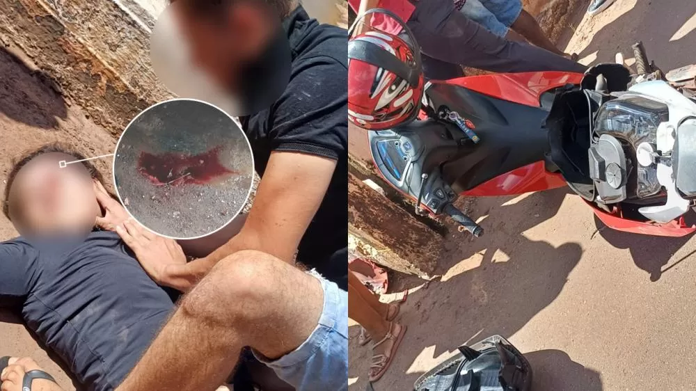 Mulher em Estado Grave com Múltiplas Fraturas no Crânio após colisão com caminhão é transferida para o HEURO em Cacoal