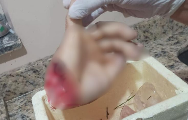 Rixa sangrenta acaba com homem tendo Mão Decepada com Terçado e Cortes Profundos no Braço e Perna em Ataque Brutal